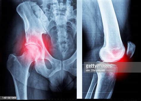 Hip Pain Anatomy Fotografías E Imágenes De Stock Getty Images