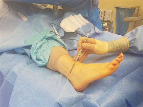 Surgical Repair Of Peroneal Tendon Tear Foot And Ankle Associates Of
