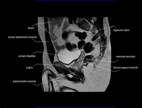 Pelvic Anatomy Ct The Pelvis Radiology Key Francis Afte1997