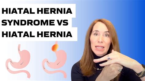 Hiatal Hernia Syndrome Vs Hiatal Hernia Youtube