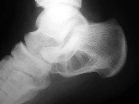 Simple Calcaneal Bone Cysts Bone And Joint