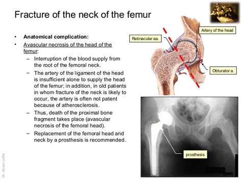Imaging Anatomy Fractures Of The Femur