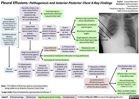 Pleural Effusions Pathogenesis And Anterior Posterior Chest X Ray Findings Calgary Guide