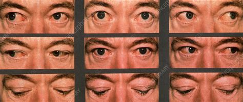 Graves Ophthalmopathy Stock Image C0365619 Science Photo Library