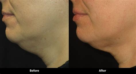 Kybella Before And After Pictures Med Spa In Encino Ca A E Skin