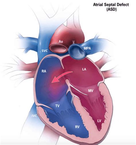 Atrial Septal Defect Asd Cardio Guide