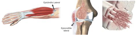 Epicondilite Lateral Dr Rom Rio Rocha Ortopedista
