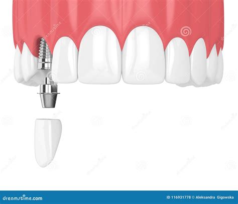 D Render Of Upper Jaw With Teeth And Dental Incisor Crown Stock