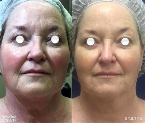 Nuface Microcurrent Facial Toning System Before After Facelift Info