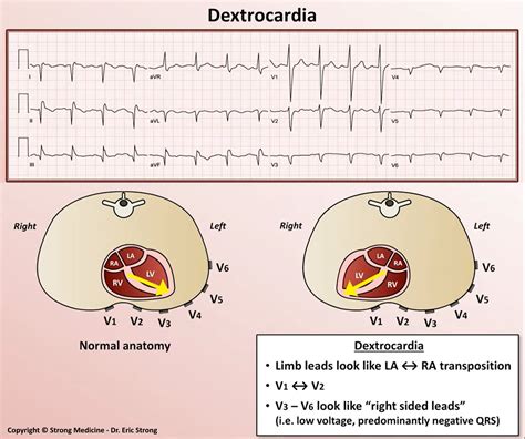 Ecg Study Card For Dextrocardia Diagnosis Cardiology