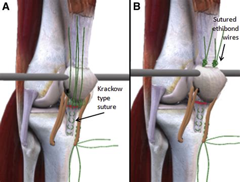 Surgical Treatment For Chronic Rupture Of The Patellar Tendon Performed