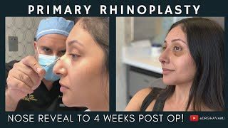 Asian Rhinoplasty In Los Angeles Wave Plastic Surgery Lupon Gov Ph