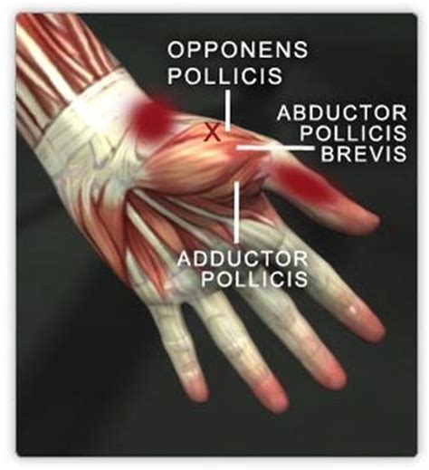 The abductor pollicis brevis is a muscle in the hand that functions as an abductor of the thumb. Abductor pollicis brevis - Location, Origin, Functions ...