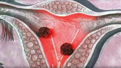 Labia Minora Cyst Pictures Bartholins Cysts Treatment Causes