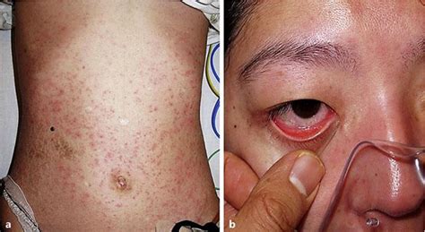 A Case Of Erythema Multiforme Major Developed After Sequential Use Of