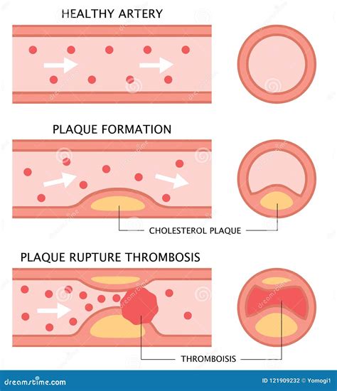 Atherosclerosis And The Artery Diagram
