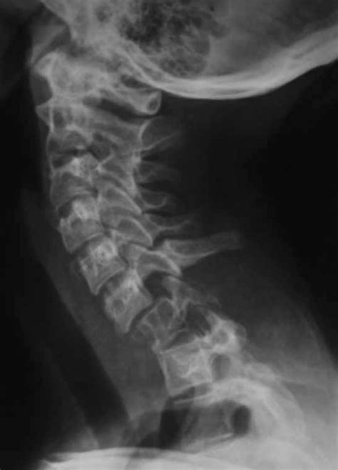 Preoperative X Ray Of The Cervicothoracic Spine Lateral View