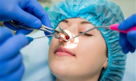 Endoscopic Septoplasty How It Can Help Your Nasal Airway Function