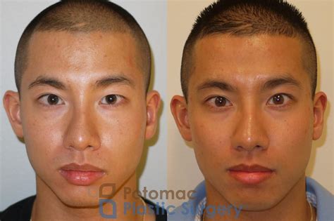 Upper Blepharoplasty On The Left Eye To Give Symmetry To The Eyelids Of