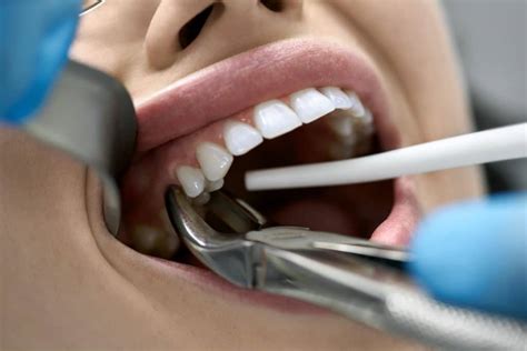 Tooth Extraction When Will Dentists Pull Teeth Dr Varley