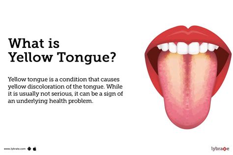 Yellow Tongue Causes Symptoms Treatment And Cost