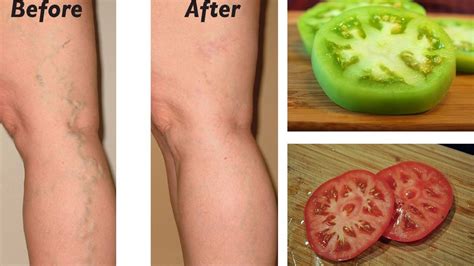 Natural Remedies For Varicose Veins Youtube