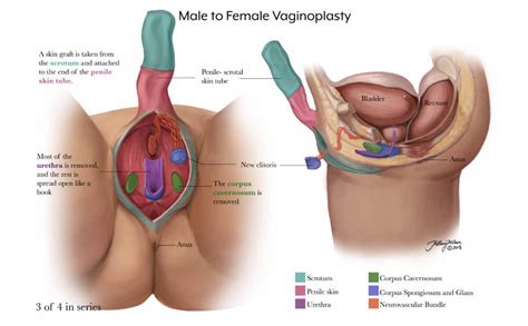 Second Type Woman Surgical Options For The Transsexual Woman