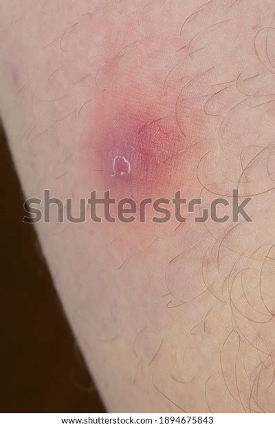 Erythema Nodosum Red Nodule Or Lump On Inner Thigh Of A Male Patient