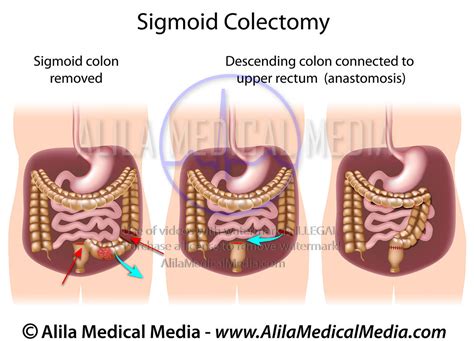 Alila Medical Media Sigmoid Colectomy Medical Illustration