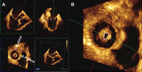 Discrepancy Between Mitral Valve Areas Measured By Two Dimensional Planimetry And Three