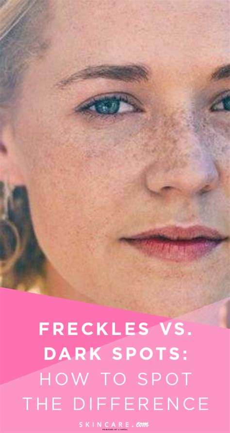 Difference Between Freckles And Sun Spots By Loréal