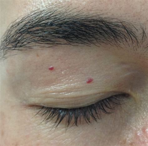Blemish Removal The Skin And Body Clinic