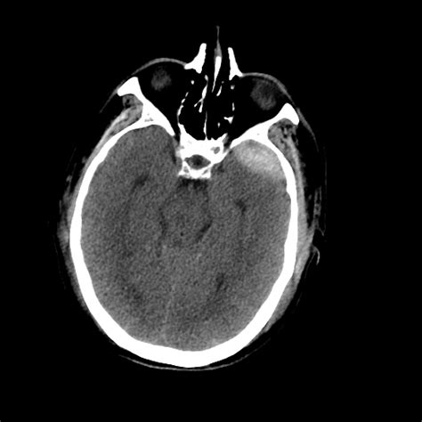 Archives Epidural Hematoma And Middle Meningeal Artery Fistula