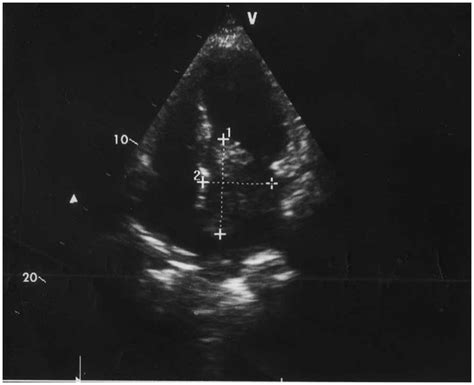 Transthoracic Echocardiogram Showed Left Atrial Mass Download
