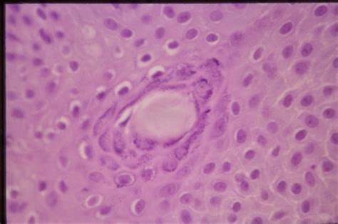 Histopathology Of Linear Sebaceous Nevus Syndrome Retina Image Bank