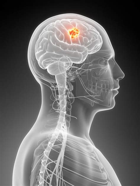 Warning Signs Of A Brain Tumor Neurosurgery Dallas Tx