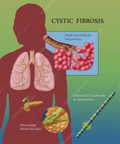 Cystic Fibrosis Illustration Stock Image C0445854 Science Photo