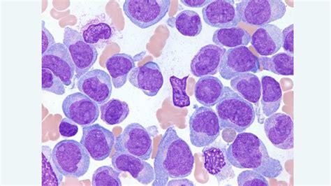 Cryo Em Provides New Insights Into Acute Myeloid Leukaemia Healthcare