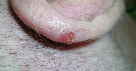 Squamous Cell Skin Cancer Photos
