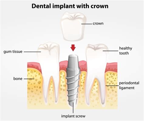 The Different Parts Of A Dental Implant Green Apple Dental
