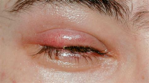 Eyelid Pimple Inside