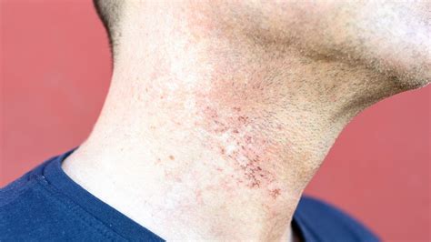 How To Treat Razor Burn Properly And Prevent It Tips For Soothing Skin