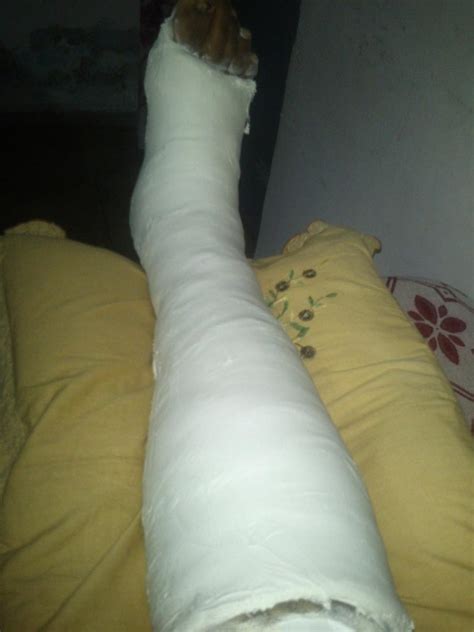 Being Blogger Broken Leg