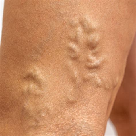 Bulging Vein Treatments And Causes The Vein Center Of Maryland