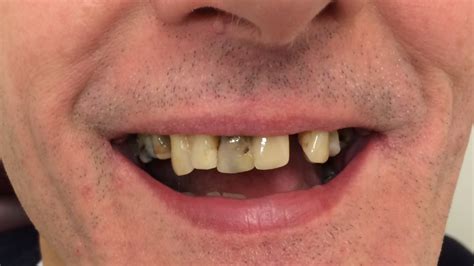 Gallery Before And After David Hilton Denture Clinic Ascot Vale