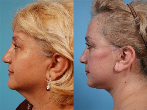 Neck Lift Before And After Pictures Case Chicago IL TLKM Plastic Surgery