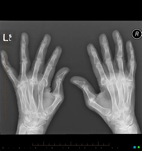 Bone damage in rheumatoid arthritis (ra) has three distinct phenotypes: Rheumatoid arthritis hands | Image | Radiopaedia.org