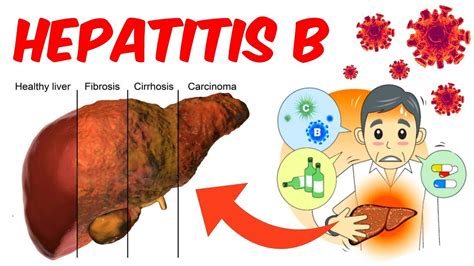 Enfermedades De Transmisión Sexual Hepatitis B