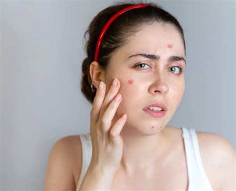 Types Of Acne Breakouts And Myths About It In Hindi Types Of Acne Breakouts And Myths About It