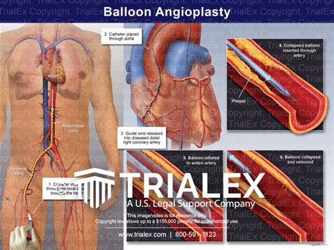 Balloon Angioplasty Trialexhibits Inc